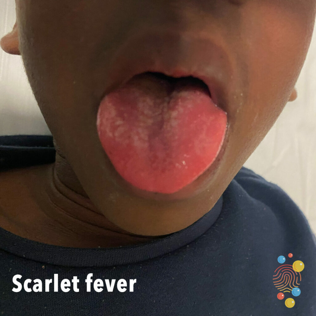 scarlett fever.jpg